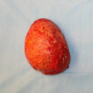 Removal of silicone implant