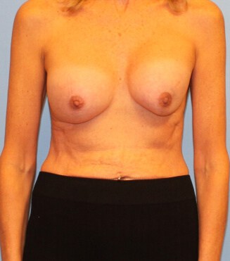 Breast surgery complications New York City