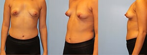 Tuberous Breasts in Women: How They Form and How To Correct Them