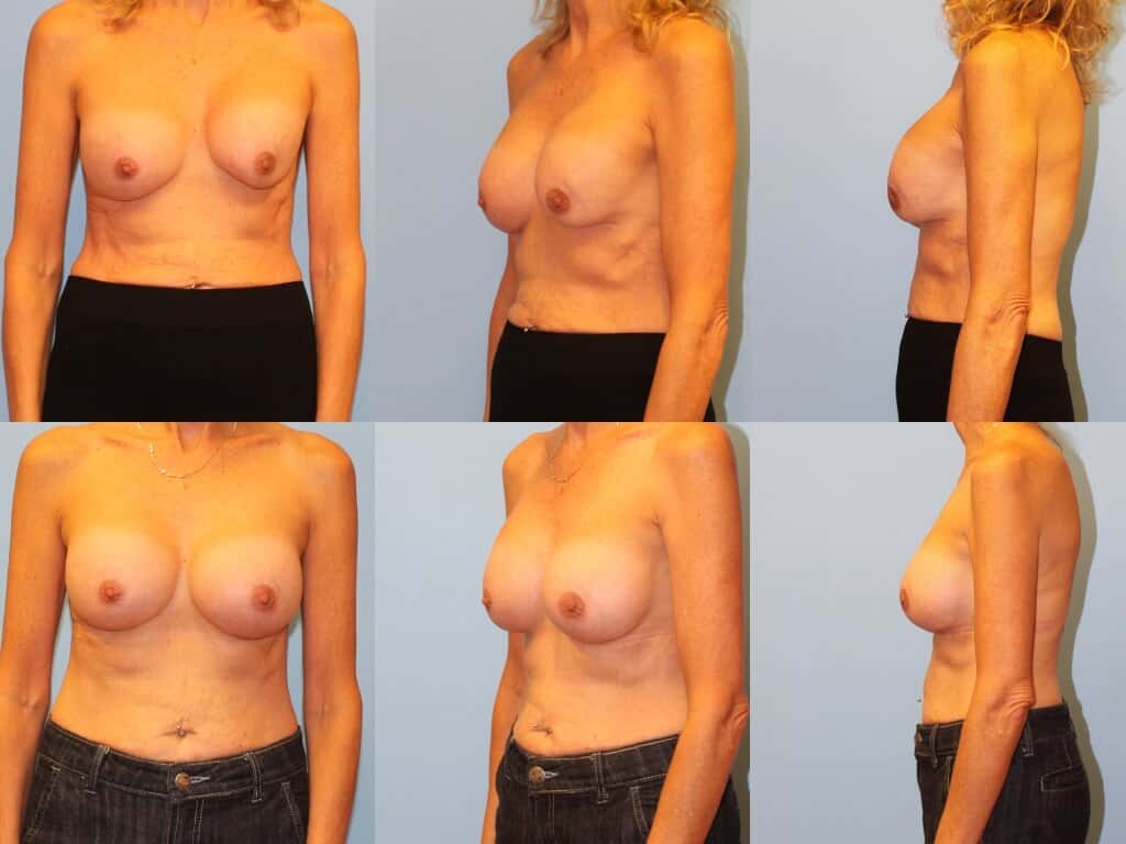 Before & after capsular contracture treatment