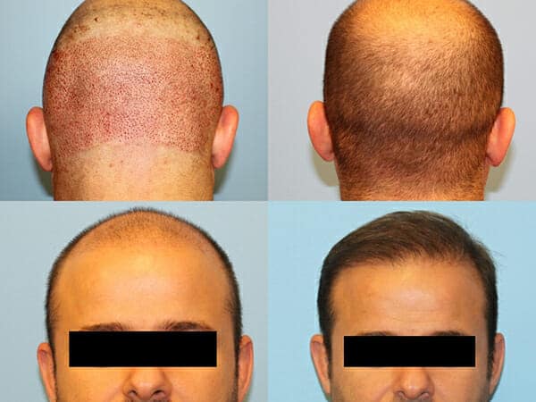 NeoGraft Hair Restoration New York City & Westchester County